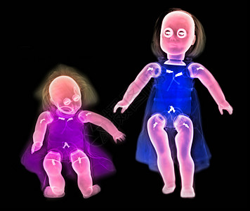 两个娃的彩色X光图片