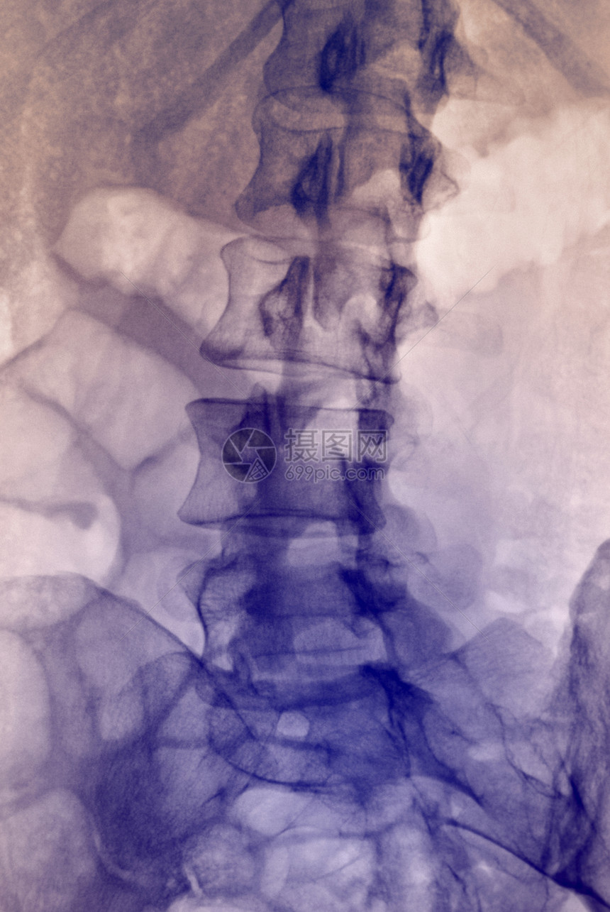 普通腰脊椎X光图片