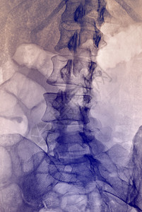 普通腰脊椎X光图片