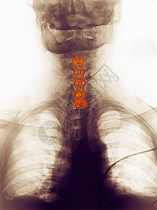 显示人工颈部发生事故的X光图片