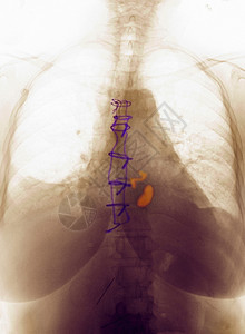 显示人工心脏阀门的胸前X光图片