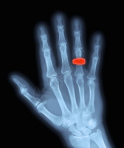 带着结婚戒指的手X光片背景图片