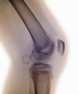 膝盖X射线图片