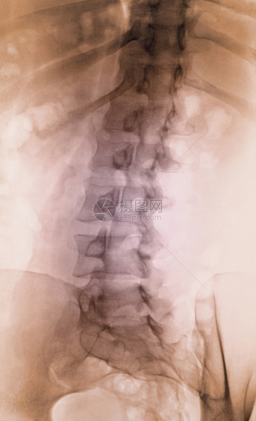 一名妇女的脊椎X光线图片