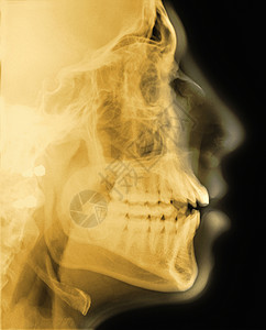 头部侧面的X光图片