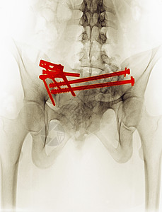 X光显示骨盆骨折手术修复图片