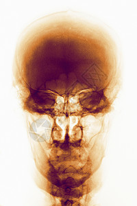 普通人头骨彩色X光图片