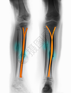 X射线显示甲状腺和纤维骨折背景图片