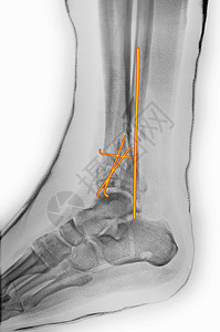 手术后脚踝骨折X光背景图片