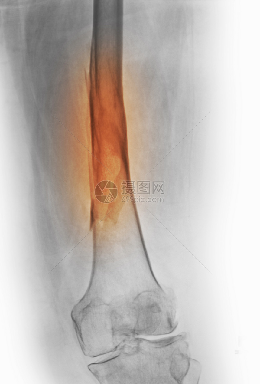 股骨折X射线图片