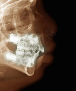一个2岁男孩的头部X光片图片