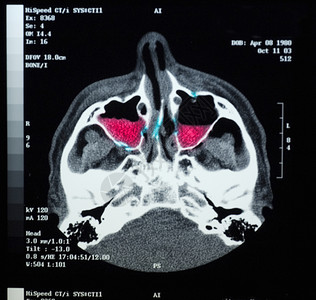 显示增强对面部骨骼进行CT扫描显示头骨折背景