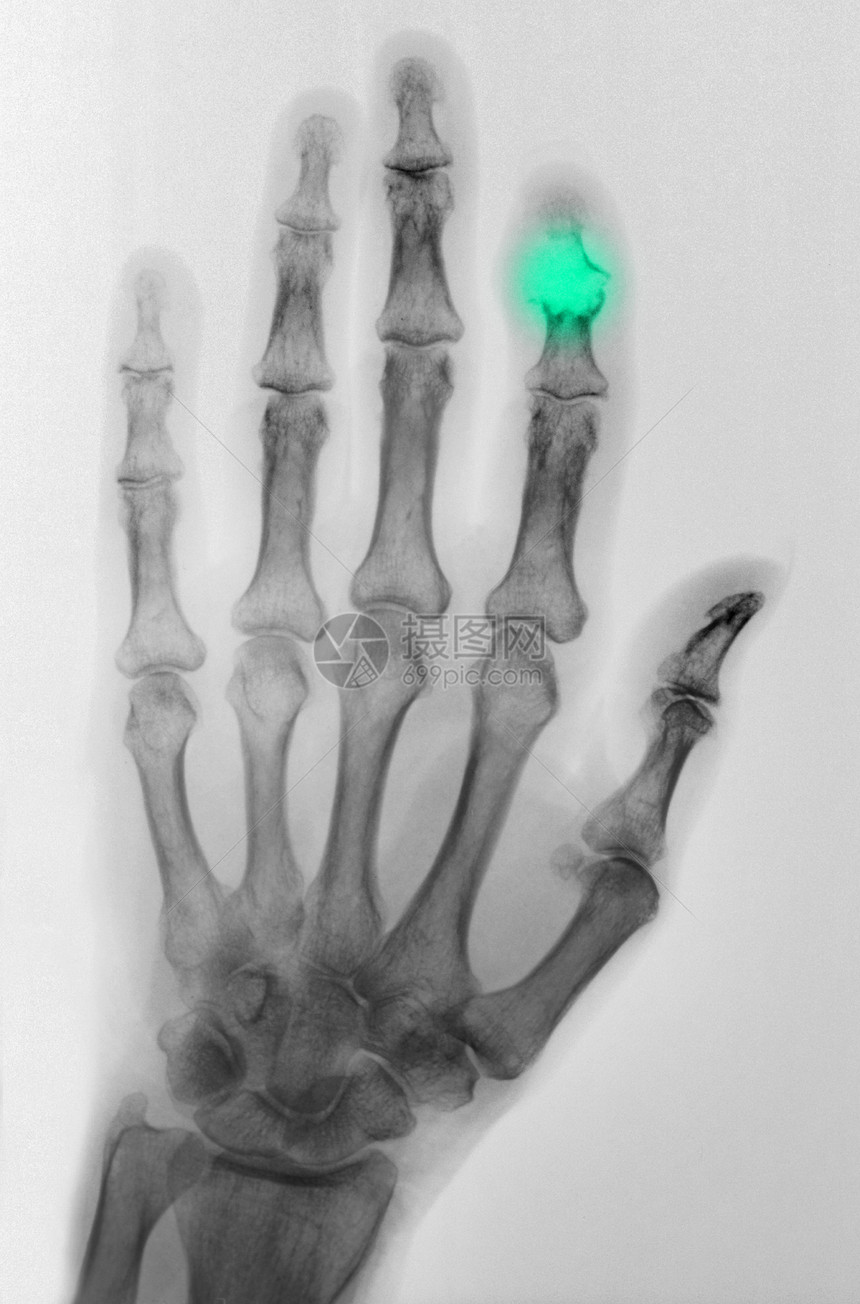 显示风湿关节炎的X光手片图片