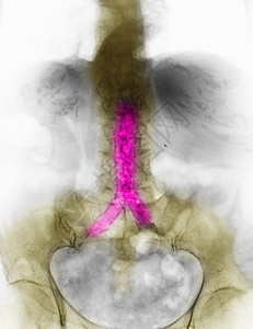 腹部X射线显示有天体硬化图片