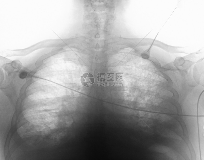 胸腔凝血心脏衰竭X射线图片