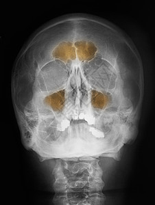 颅骨的X射线图片