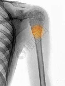 X射线显示直径角的humerus骨折图片