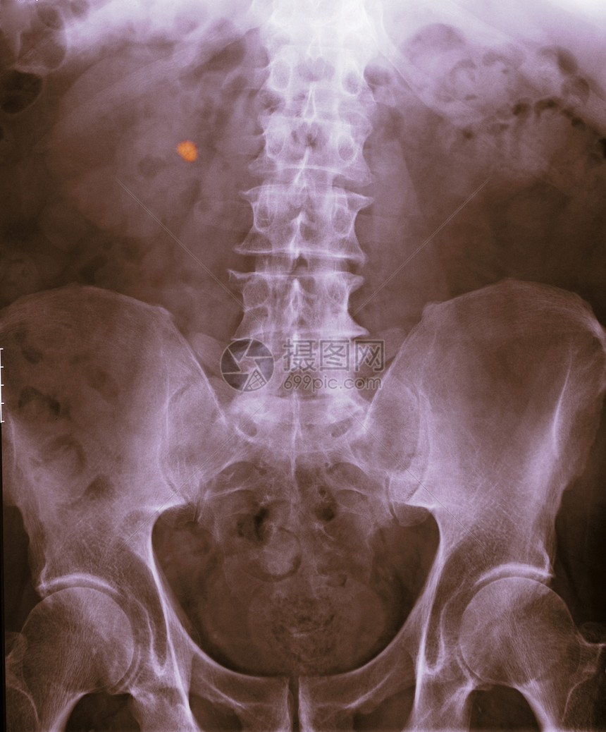 abdomenX光片显示肾脏有结石图片