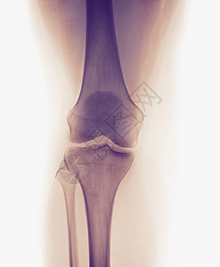 一名3岁女孩的正常膝盖X光图片