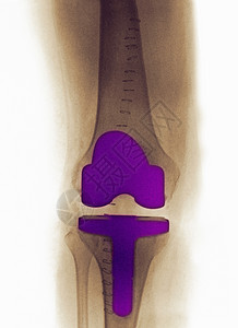 一名61岁女子的关节炎膝盖X光图片
