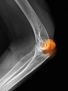 鹰嘴骨折的x线检查图片