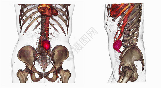 两张心腹动脉的CT扫描图像高清图片