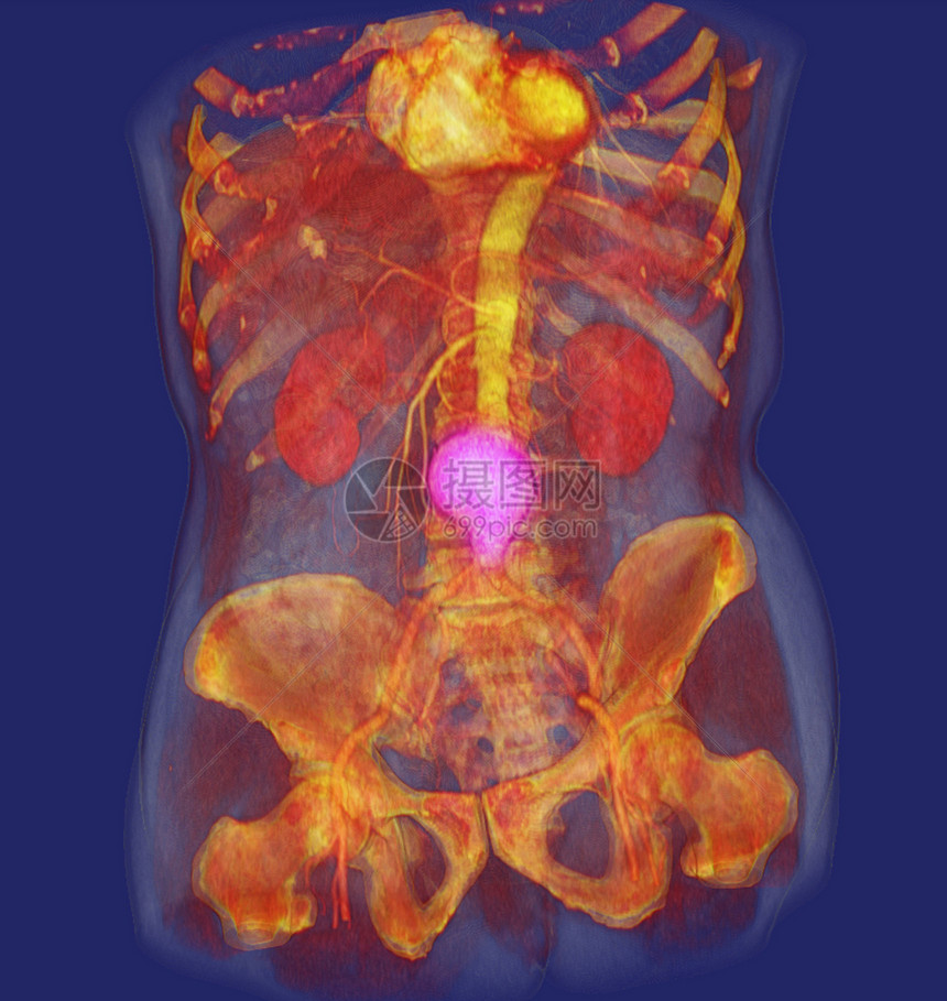 CT显示腹部动脉图像图片