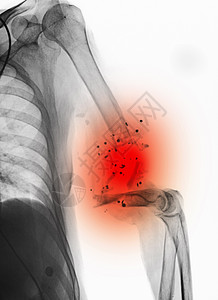 X光显示肱骨有伤图片