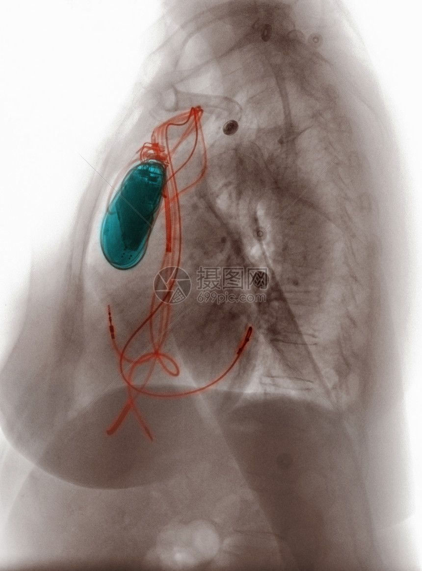 胸部心脏起搏器X光显示图片