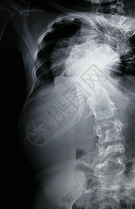 胸腔X光显示骨质疏松背景图片