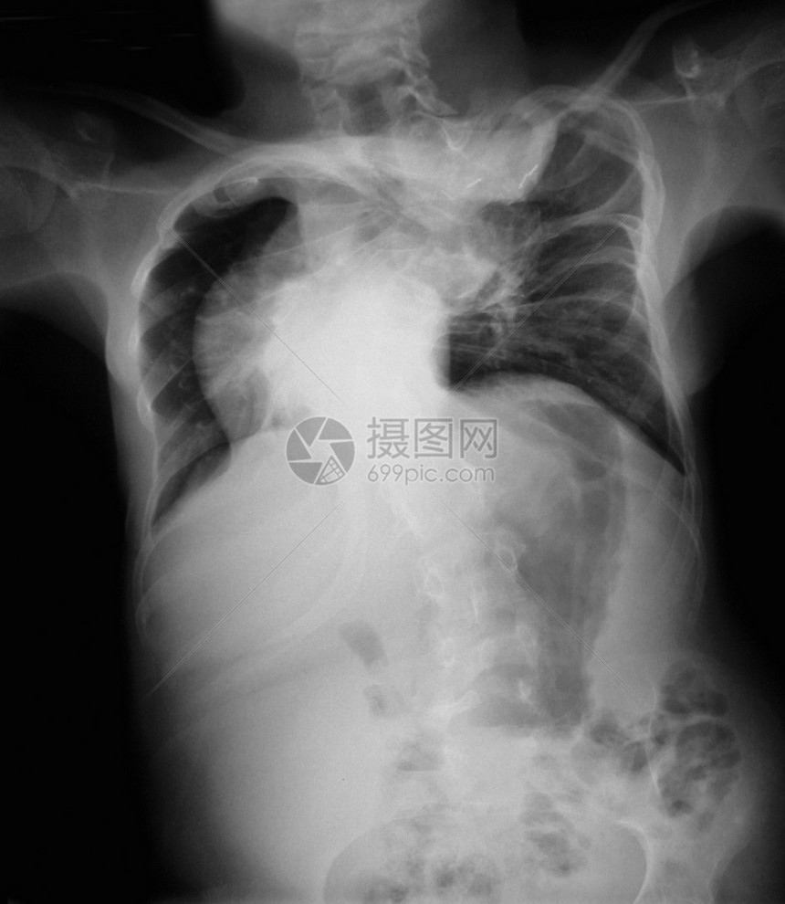 骨质疏松的胸腔X光显示图片