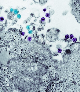 人体免疫机能丧失艾滋的TEM图片