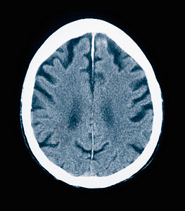 CT扫描84岁男阿尔茨海默病患者图片