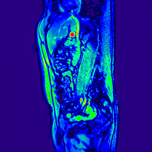 对60岁患有肾结石的男病人侧视图abdomenMRI扫描图片