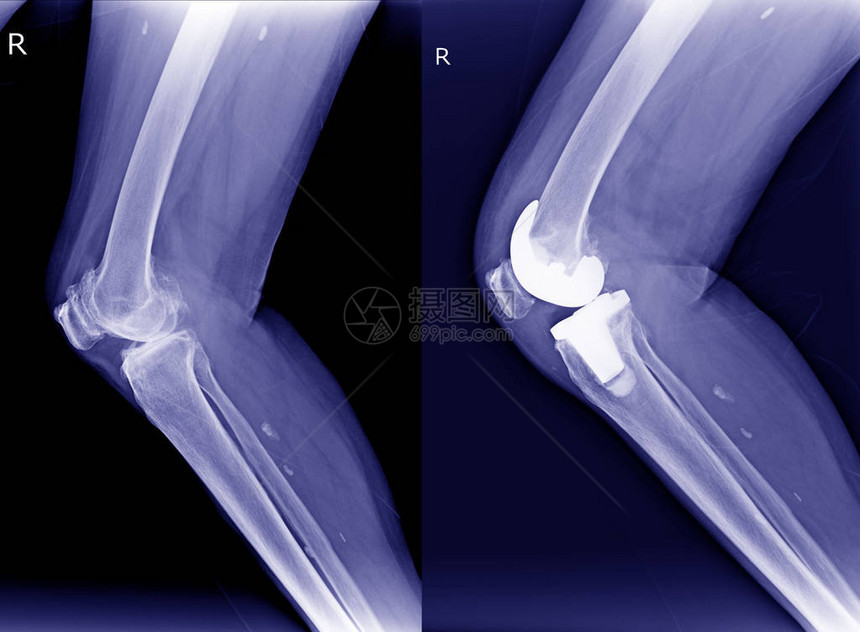 X射线膝盖右骨髓炎OA和手术后关节图片