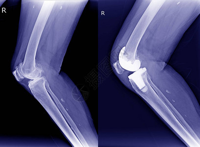 X射线膝盖右骨髓炎OA和手术后关节背景图片