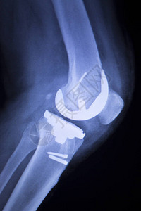 Knee联合植入替换X光在整形外伤图片