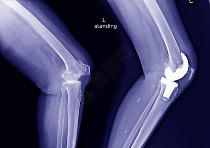 膝盖左侧骨髓炎OA和手术后关节背景图片