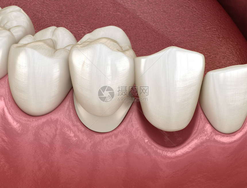 由陶瓷前牙复原而成的桥医学上准确无误的牙科图片