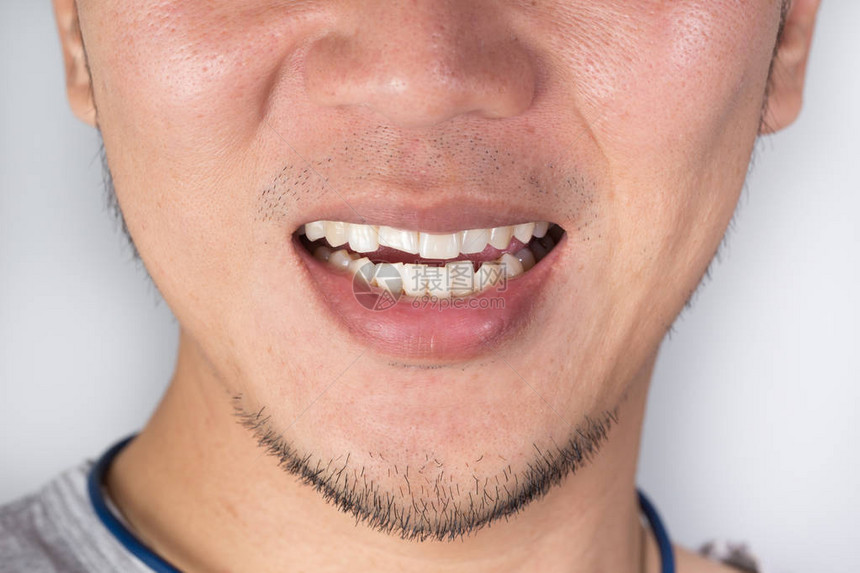 丑陋的微笑牙齿问题男牙齿受伤或牙齿断裂受伤牙齿的创伤和神经损伤图片