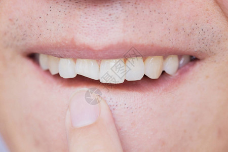 男牙齿破损前牙断裂需要牙背景