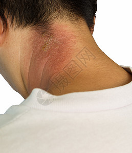 白色背景中孤立的亚洲女颈部发痒的皮疹图片