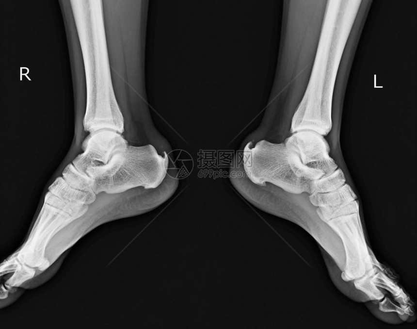 X光两只脚的足部跳动显示卡尔内图片
