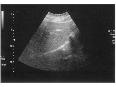 腹部诊断凝结石的超声图片