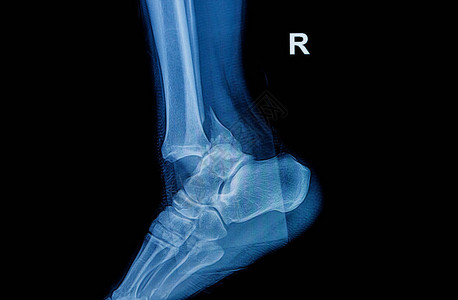 踝关节腓骨折腿骨腿侧X光片和视图图片