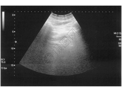腹部诊断凝结石的超声图片