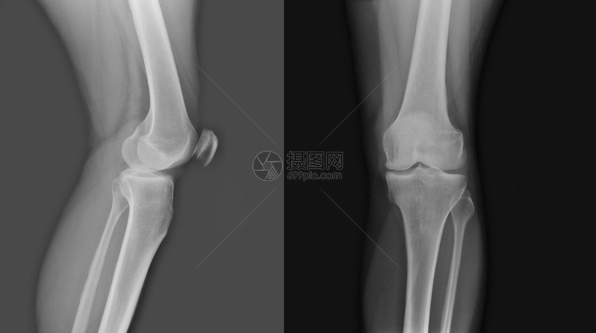 两个人膝盖的X射线图片