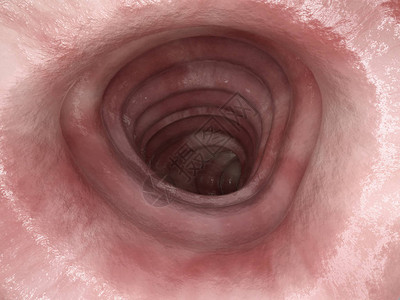 结肠息肉溃疡结肠炎第0阶段插画