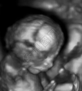 三个维度的胎儿超声波图片