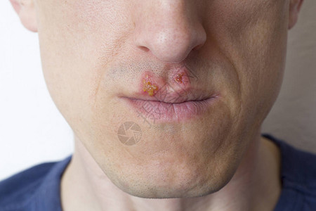 男人嘴唇上的疱疹背景图片
